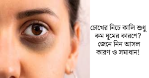 Read more about the article চোখের নিচে কালি শুধু কম ঘুমের কারণে? জেনে নিন আসল কারণ ও সমাধান!